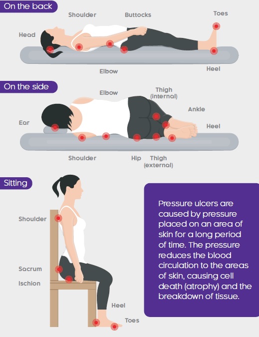 Skin Pressure Damage Leaflet Everyone Is At Risk Hints And Tips For